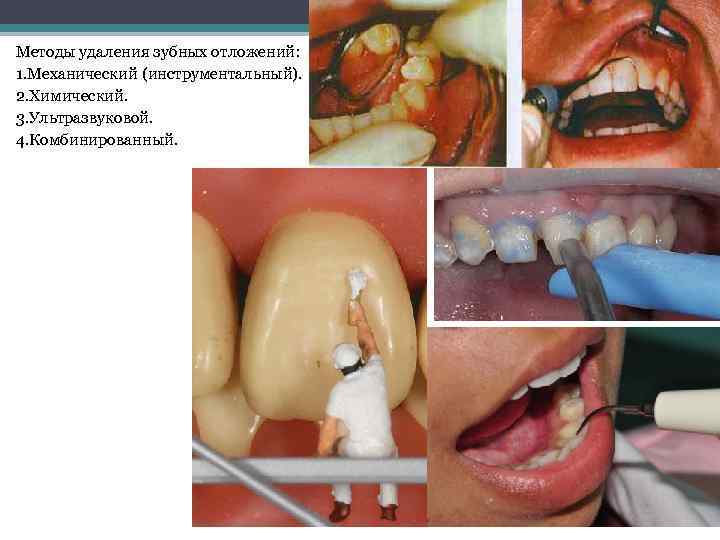 Методы удаления зубных отложений: 1. Механический (инструментальный). 2. Химический. 3. Ультразвуковой. 4. Комбинированный. 
