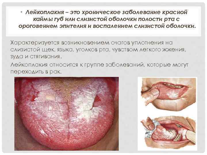  • Лейкоплакия – это хроническое заболевание красной каймы губ или слизистой оболочки полости