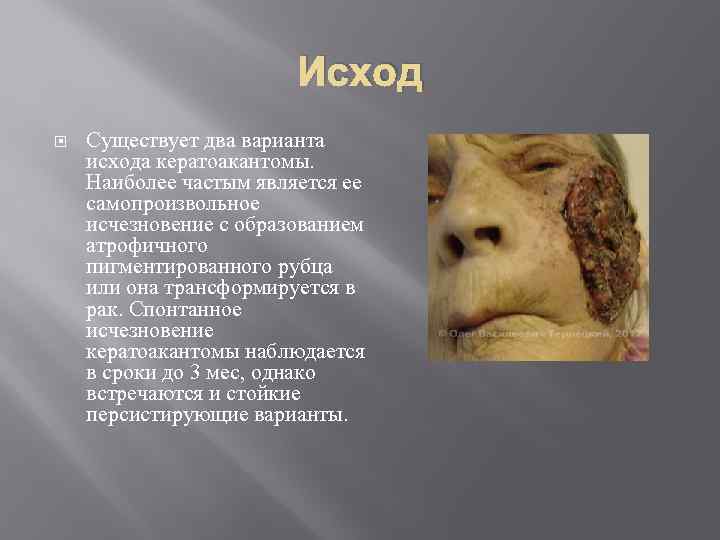 Исход Существует два варианта исхода кератоакантомы. Наиболее частым является ее самопроизвольное исчезновение с образованием