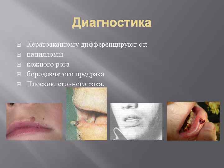 Диагностика Кератоакантому дифференцируют от: папилломы кожного рога бородавчатого предрака Плоскоклеточного рака. 