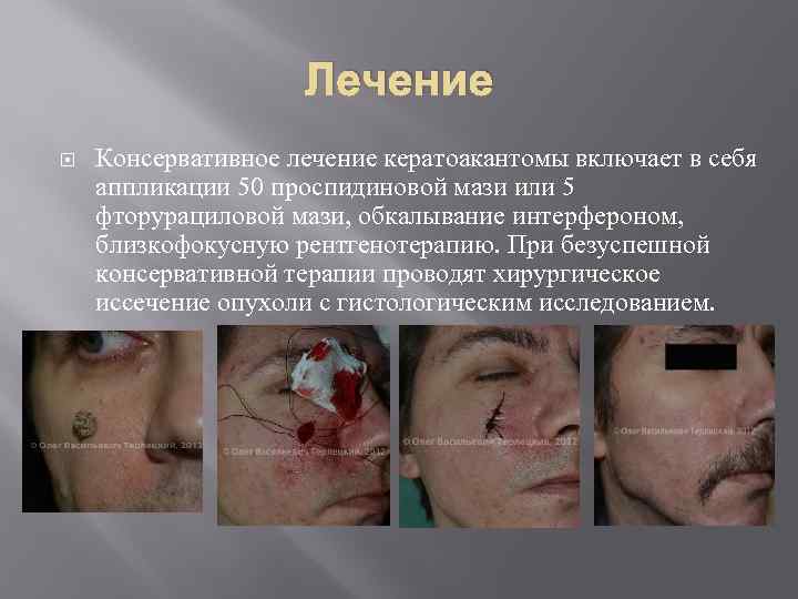 Лечение Консервативное лечение кератоакантомы включает в себя аппликации 50 проспидиновой мази или 5 фторурациловой