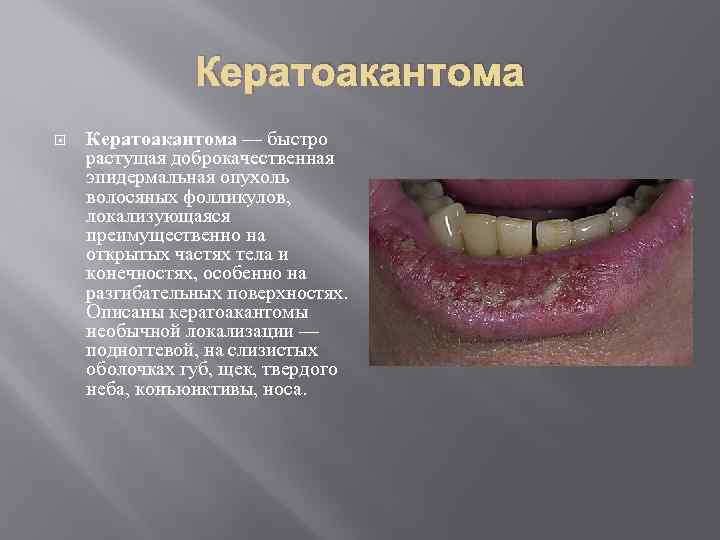 Кератоакантома — быстро растущая доброкачественная эпидермальная опухоль волосяных фолликулов, локализующаяся преимущественно на открытых частях