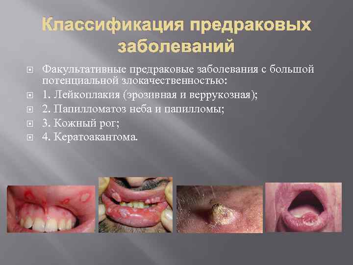 Классификация предраковых заболеваний Факультативные предраковые заболевания с большой потенциальной злокачественностью: 1. Лейкоплакия (эрозивная и