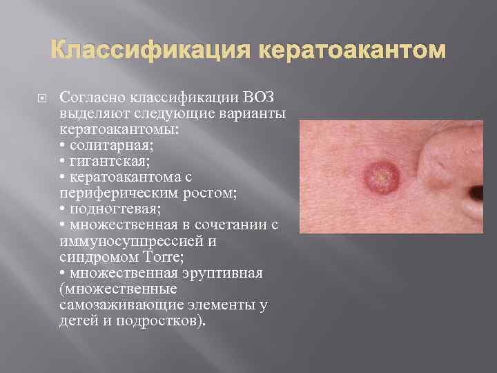 Классификация кератоакантом Согласно классификации ВОЗ выделяют следующие варианты кератоакантомы: • солитарная; • гигантская; •
