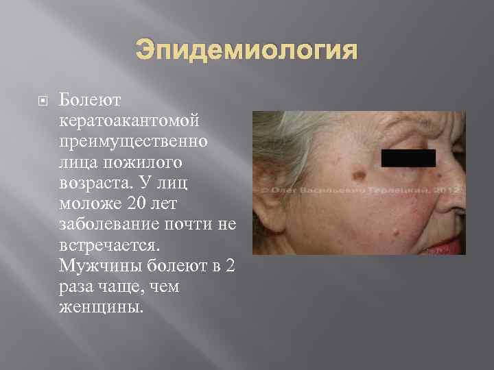 Эпидемиология Болеют кератоакантомой преимущественно лица пожилого возраста. У лиц моложе 20 лет заболевание почти