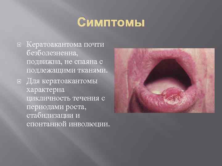 Симптомы Кератоакантома почти безболезненна, подвижна, не спаяна с подлежащими тканями. Для кератоакантомы характерна цикличность