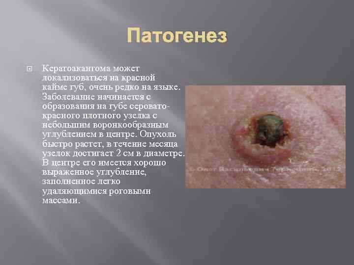 Патогенез Кератоакантома может локализоваться на красной кайме губ, очень редко на языке. Заболевание начинается