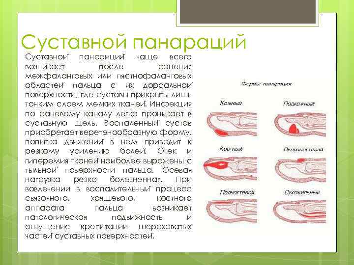 Суставной панараций Суставнои панариции чаще всего возникает после ранения межфаланговых или пястнофаланговых областеи пальца