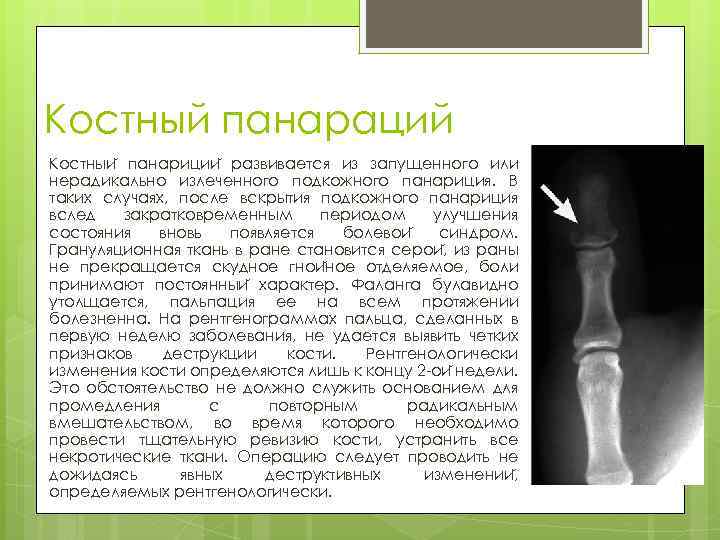 Костный панараций Костныи панариции развивается из запущенного или нерадикально излеченного подкожного панариция. В таких