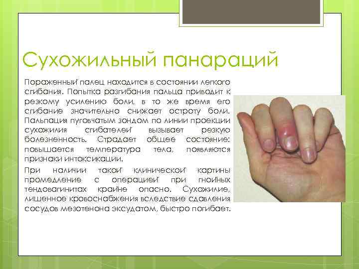 Сухожильный панараций Пораженныи палец находится в состоянии легкого сгибания. Попытка разгибания пальца приводит к