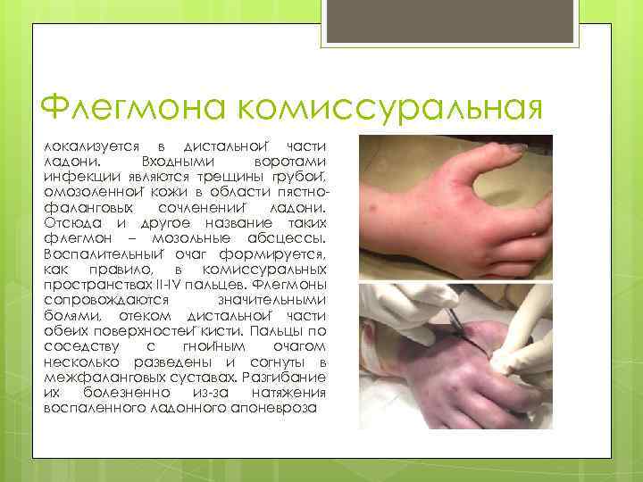 Флегмона комиссуральная локализуется в дистальнои части ладони. Входными воротами инфекции являются трещины грубои ,