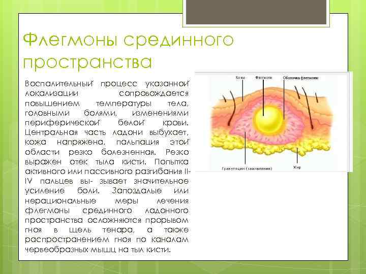 Флегмоны срединного пространства Воспалительныи процесс указаннои локализации сопровождается повышением температуры тела, головными болями, изменениями