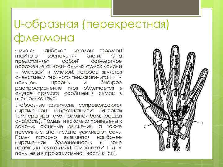 U-образная (перекрестная) флегмона является наиболее тяжелои формои гнои ного воспаления кисти. Она представляет собои