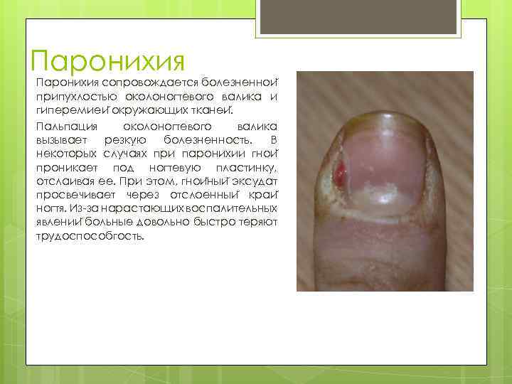 Паронихия сопровождается болезненнои припухлостью околоногтевого валика и гиперемиеи окружающих тканеи. Пальпация околоногтевого валика вызывает