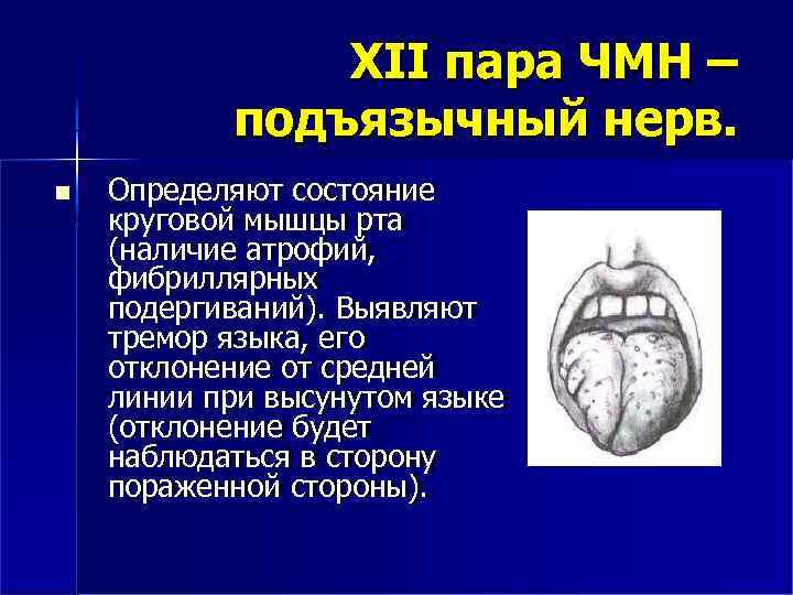 XII пара ЧМН – подъязычный нерв. Определяют состояние круговой мышцы рта (наличие атрофий, фибриллярных