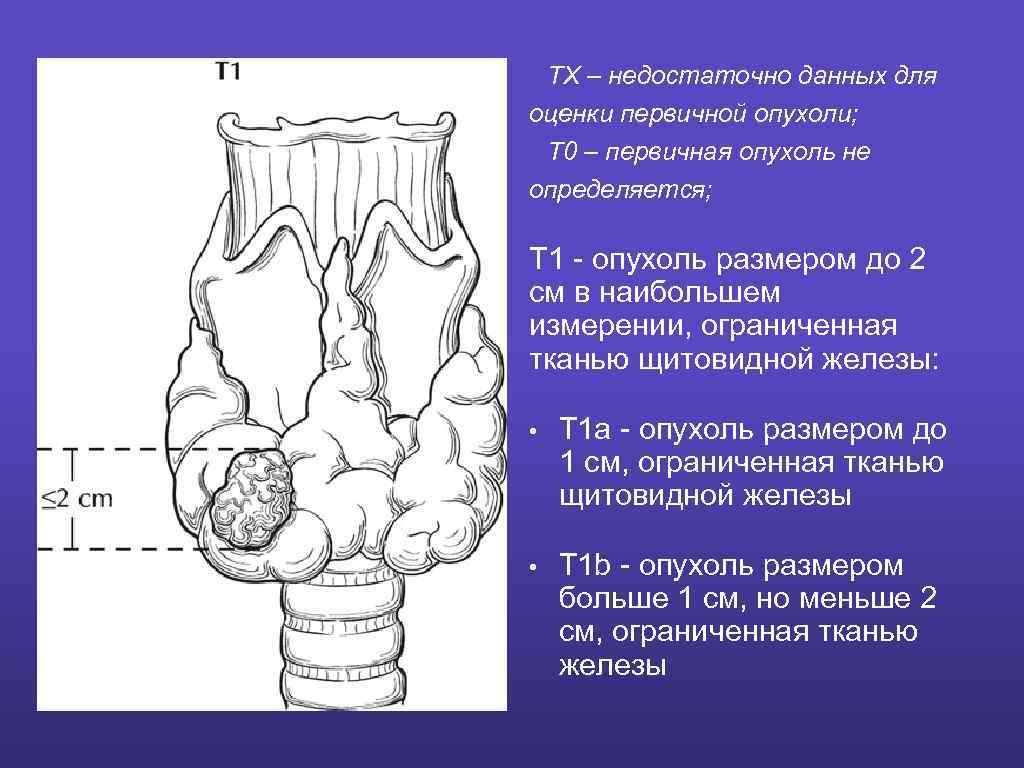 ТХ – недостаточно данных для оценки первичной опухоли; Т 0 – первичная опухоль не