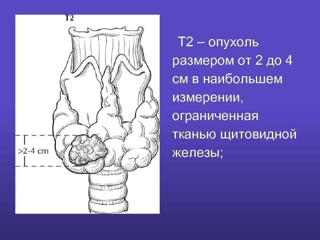 Т 2 – опухоль размером от 2 до 4 см в наибольшем измерении, ограниченная