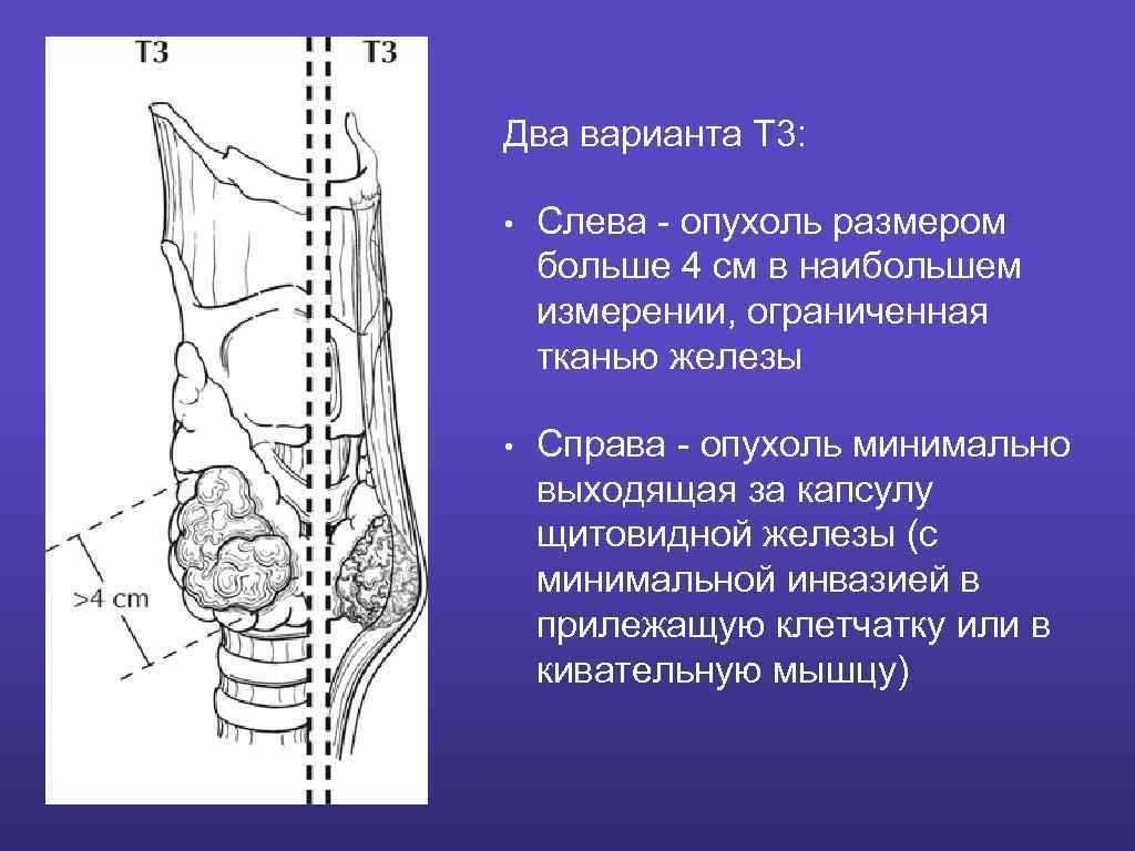 Капсула железы. Капсула щитовидной железы. Инвазия в капсулу щитовидной железы. Капсула щитовидной железы ткань. Наружной и внутренней капсулами щитовидной железы.