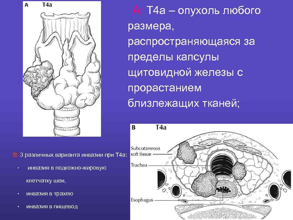 A: Т 4 а – опухоль любого размера, распространяющаяся за пределы капсулы щитовидной железы