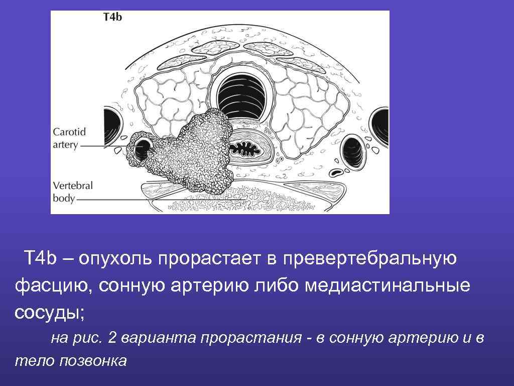 T 4 b – опухоль прорастает в превертебральную фасцию, сонную артерию либо медиастинальные сосуды;