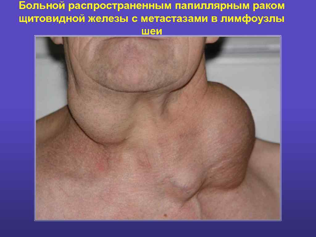 рак на щитовидната жлеза