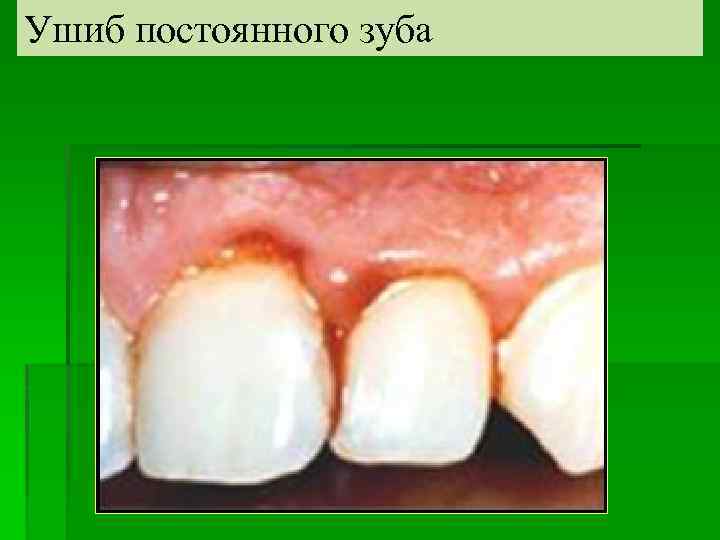 Ушиб постоянного зуба 
