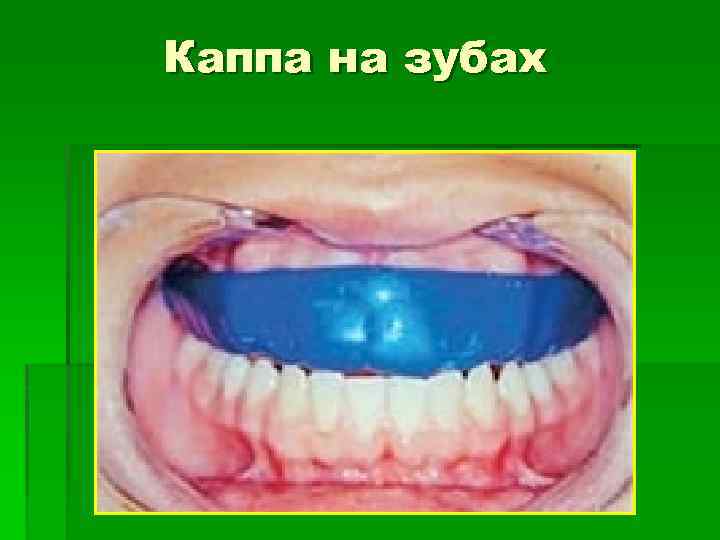 Каппа на зубах 