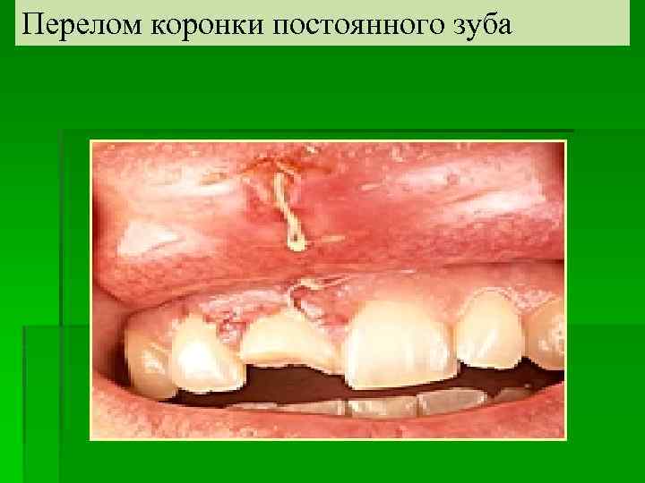 Перелом коронки постоянного зуба 
