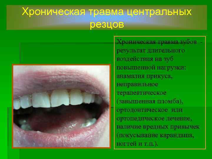 Хроническая травма центральных резцов Хроническая травма зубов результат длительного воздействия на зуб повышенной нагрузки: