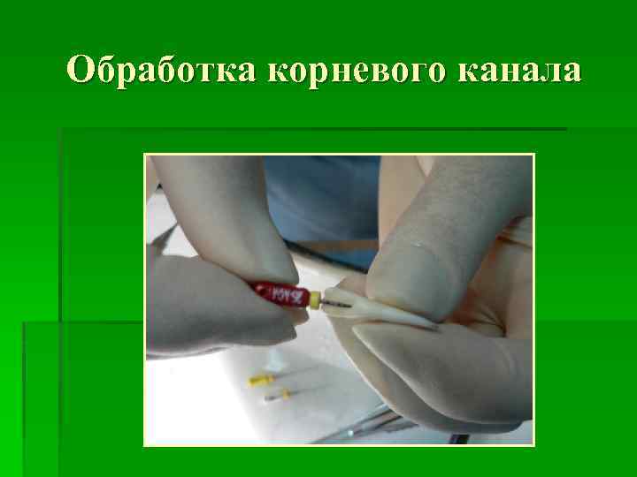 Обработка корневого канала 