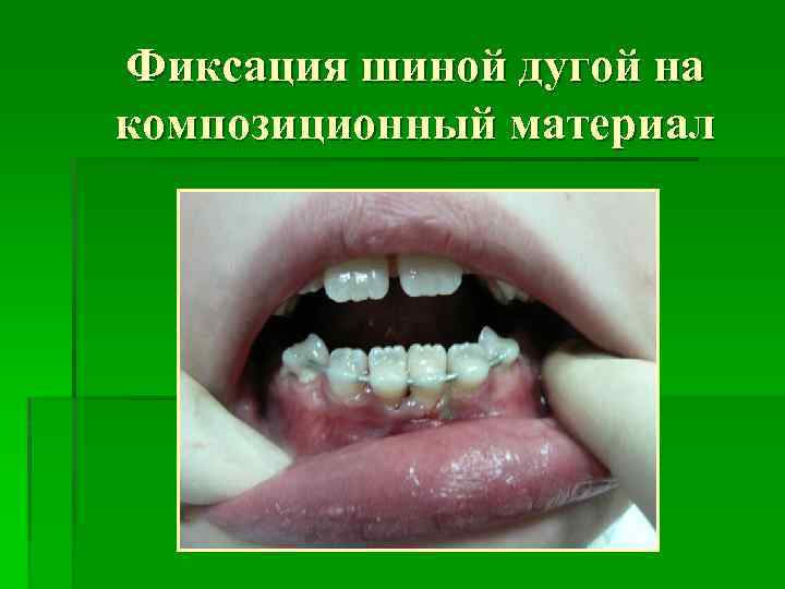 Фиксация шиной дугой на композиционный материал 