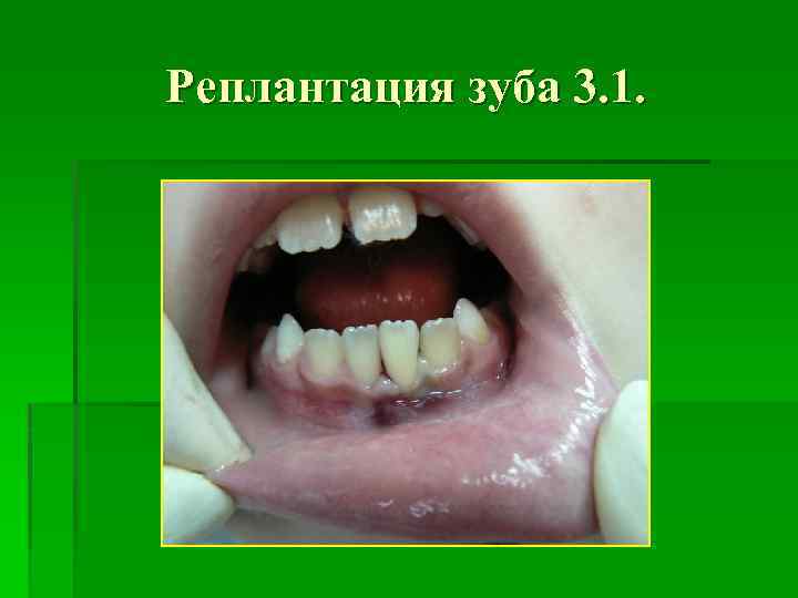 Реплантация зуба 3. 1. 