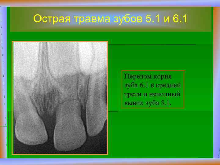 Острая травма зубов 5. 1 и 6. 1 Перелом корня зуба 6. 1 в