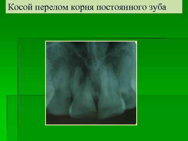 Косой перелом корня постоянного зуба 