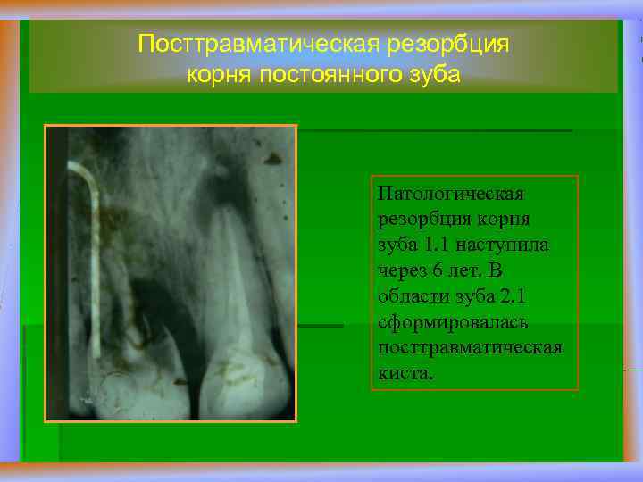 Посттравматическая резорбция корня постоянного зуба Патологическая резорбция корня зуба 1. 1 наступила через 6