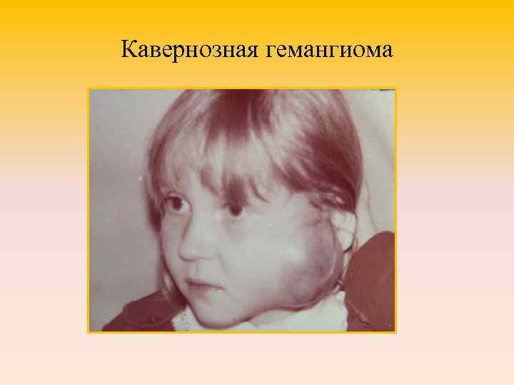 Кавернозная гемангиома 