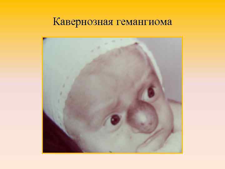 Кавернозная гемангиома 