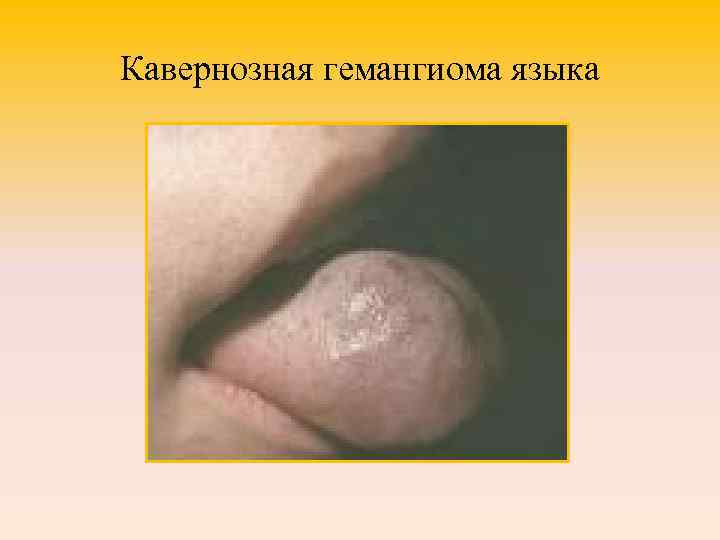 Кавернозная гемангиома языка 