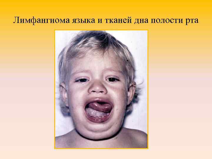 Лимфангиома языка и тканей дна полости рта 