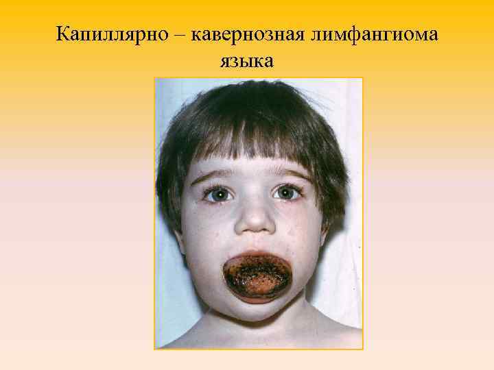 Капиллярно – кавернозная лимфангиома языка 