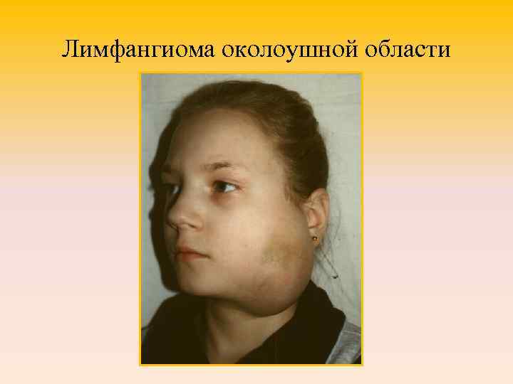 Лимфангиома околоушной области 