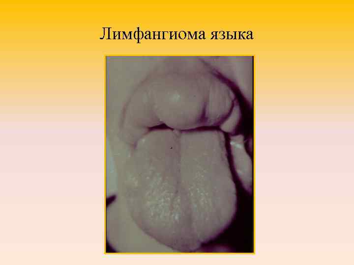 Лимфангиома языка 