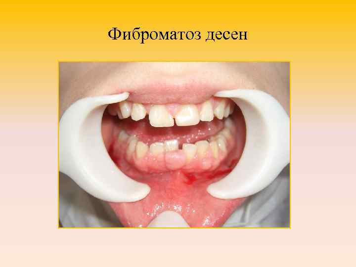 Фиброматоз десен 