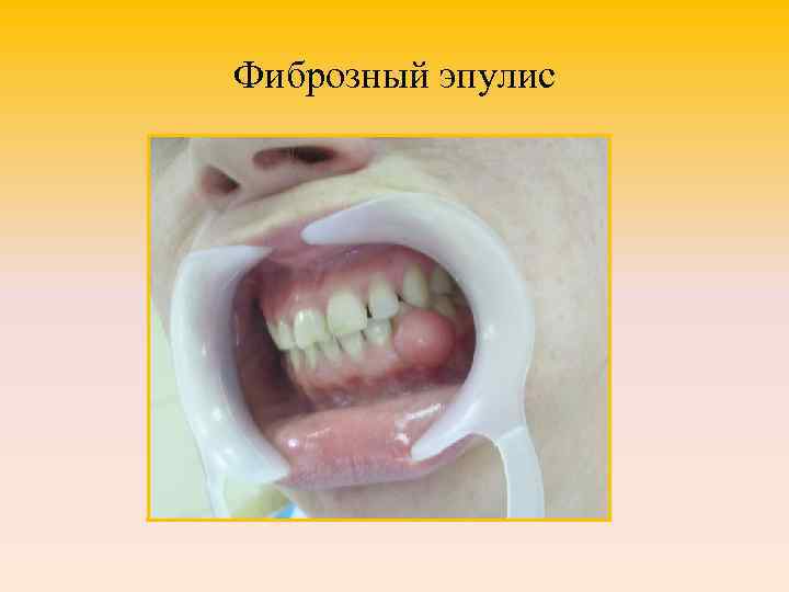 Фиброзный эпулис 