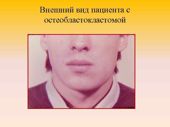 Внешний вид пациента с остеобластокластомой 