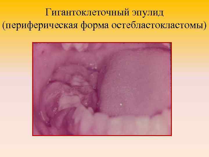 Гигантоклеточный эпулид (периферическая форма остебластокластомы) 