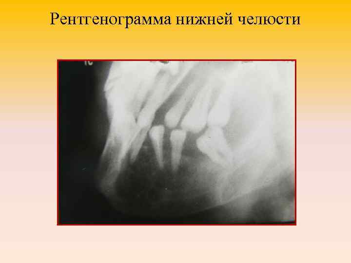 Рентгенограмма нижней челюсти 