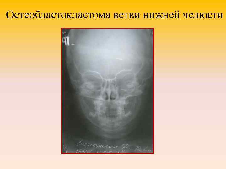 Остеобластокластома ветви нижней челюсти 