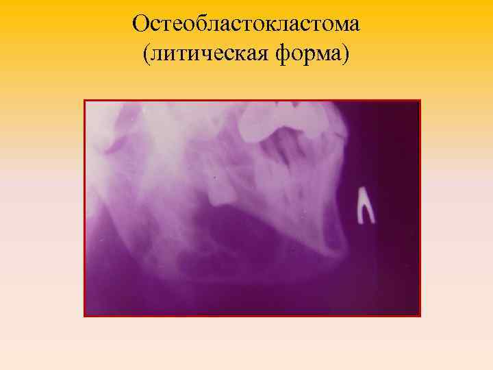 Остеобластокластома (литическая форма) 