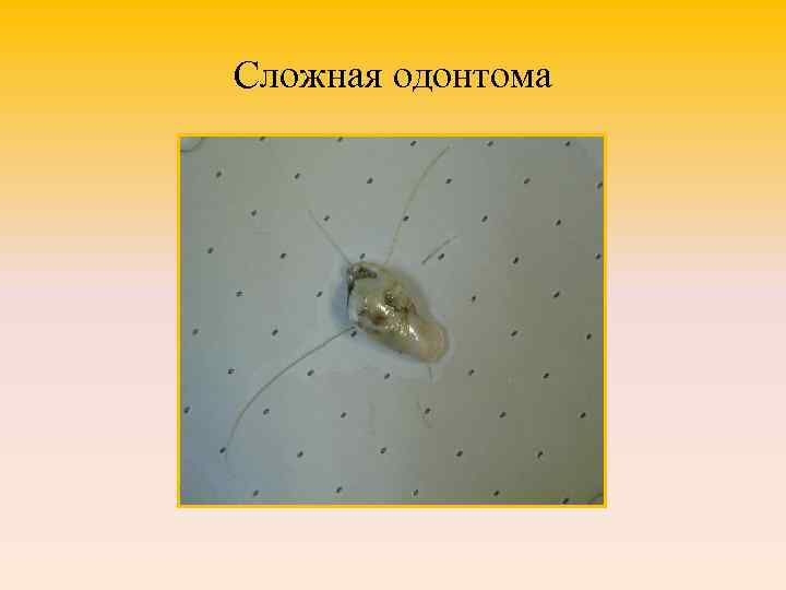 Сложная одонтома 
